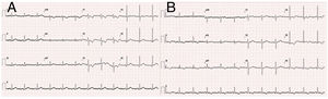 Electrocardiogram on admission (A) and 60 min later (B) (25 mm/s; 10 mm/mV).