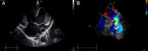 Echocardiogram. (A) Four-chamber view showing a large interventricular communication and severely dilated coronary sinus; (B) aortic arch, showing the origin of two major aortopulmonary collateral arteries.