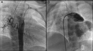 Cardiac angiography. (A) Emergence of a large and slightly tortuous major aortopulmonary collateral artery; (B) left juxtaposition of the atrial appendages.