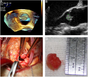 Papillary fibroelastoma of the aortic valve. (A and B) Transesophageal echocardiographic view; (C) photograph of the lesion in situ in the operating room; (D) tumor 1.0 mm×0.8 mm×0.5 mm with characteristic flower-like appearance.