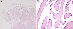 Microscopic appearance of papillary fibroelastoma. (A) Panoramic view of the lesion showing avascular branching fronds lined by endothelial cells (hematoxylin/eosin stain, original magnification ×16); (B) the fronds consist of a fibrous core surrounded by loose connective tissue and an endothelial lining (hematoxylin/eosin stain, original magnification ×100).