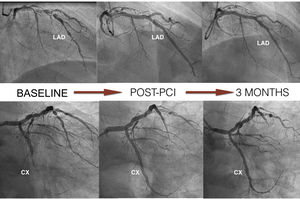Coronary angiography at baseline, post-percutaneous intervention with implantation of Magmaris devices, and follow-up at three months. CX: circumflex; LAD: left anterior descending.