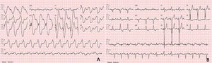 A: Electrocardiogram (ECG) showed widened QRS complexes with sine wave appearance; B: ECG showed sinus rhythm with pacemaker-mediated ventricular conduction.