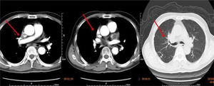 Computed tomography scan performed three months previously, showing that tissue derived from the upper right mediastinum had already severely compressed and narrowed the superior vena cava. Obstructive pneumonia, a pulmonary metastatic node and bronchial stenosis can be seen.