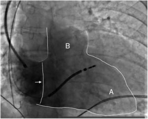Fluoroscopic image of the right ventricle (outlined in white) in right anterior oblique view at 30° with contrast, showing the tricuspid valve (arrow), the right ventricular apex (A) and the right ventricular outflow tract (B). An active fixation cardioverter-defibrillator lead is also visible, with its tip in the upper-mid septal region (Silva Cunha P, Oliveira M).