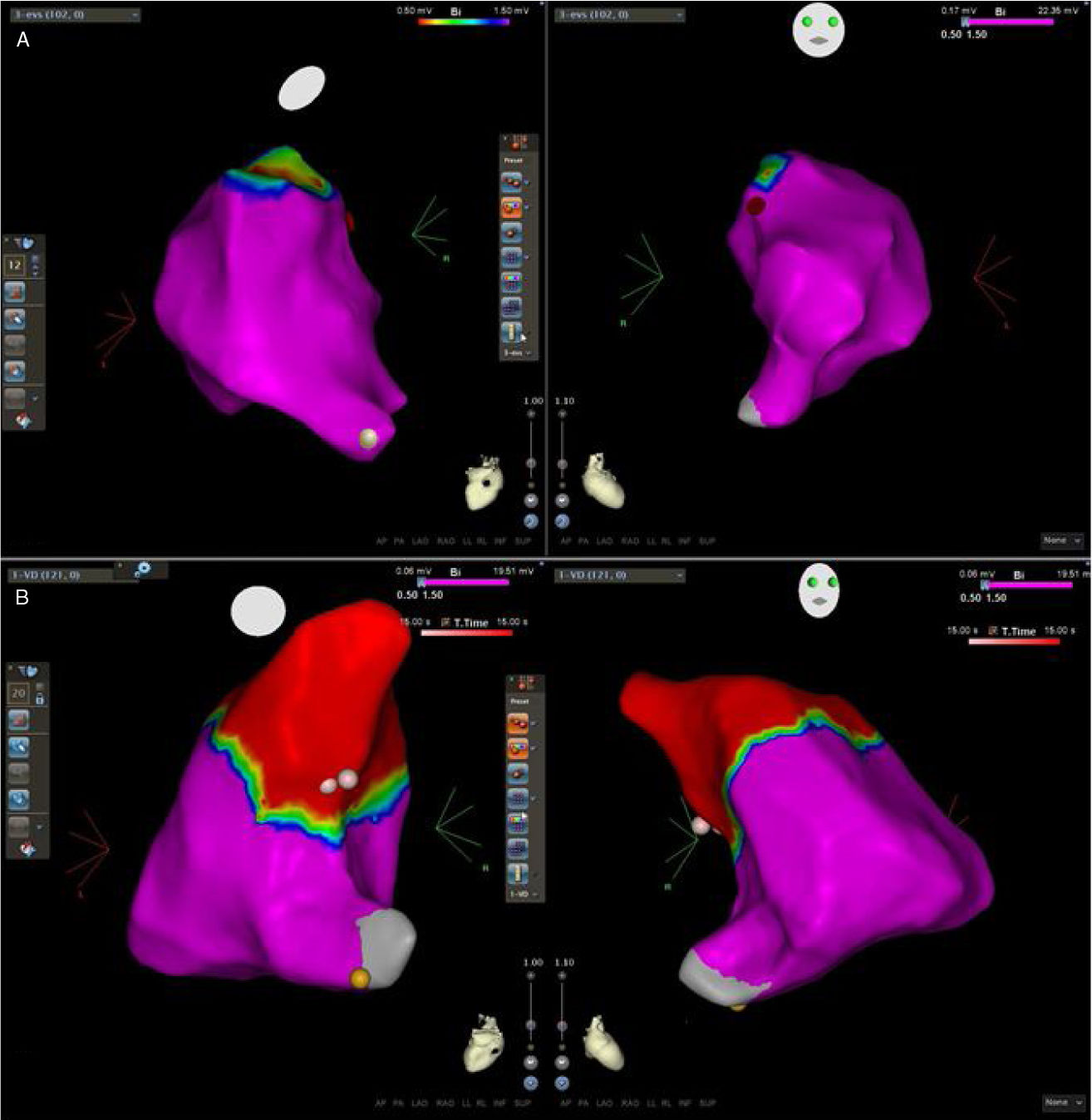 Premature ventricular contractions of the right ventricular outflow ...