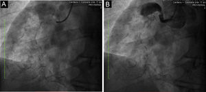 Right coronary angiogram. (A) Calcified giant aneurysm of the right coronary artery is easier to see on the fluoroscopy; (B) total thrombotic occlusion of the proximal right coronary artery.