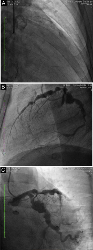 Left coronary angiogram. Fluoroscopy (A) and left coronary angiography (B) and (C) show arterial ectasia and calcification with serial aneurysms and significant stenosis in the proximal anterior descending coronary artery.