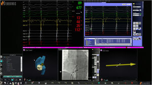 Navigant workstation screen: junctional rhythm during radiofrequency delivery (top panel); reference X-ray image in left anterior oblique view displaying the real-time position of the ablation catheter, His bundle catheter and His bundle location (white dots); the magnetic navigation system's automatic vector to slow pathway location (vector).