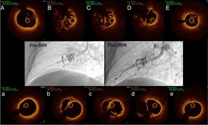 (A-E) Optical coherence tomography of A8 segment of the right lower lobe documenting a web lesion (type B); Pre-BPA: angiogram before balloon pulmonary angioplasty; Post-BPA: angiogram after balloon pulmonary angioplasty; (a-e) optical coherence tomography of A8 segment after dilation with semicompliant balloons (2.0 and 3.0 mm diameter at 58.8 Psi) documenting recanalization of the web lesion.