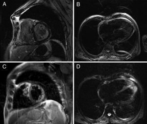 Cardiac magnetic resonance: delayed enhancement sequence showing diffuse intramyocardial enhancement of both ventricles, suggesting presence of fibrosis.