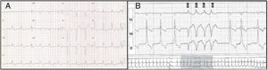 Patient 3: baseline 12-lead electrocardiogram and 24-hour Holter monitoring showing left ventricular hypertrophy (A) and runs of nonsustained ventricular tachycardia (B).