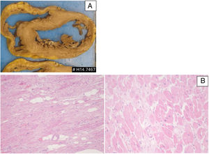 Patient 3: pathologic features of the explanted heart. (A) Macroscopy of heart section revealing features of dilated cardiomyopathy; (B) microscopic features (H&E stain) revealing interstitial fibrosis, hypertrophic cardiomyocytes and scattered adipocytes (left: low power; right: high power).