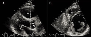 Measurement of EAT thickness. (A) Parasternal long-axis view; (B) parasternal short-axis view. Ao: aorta; EAT: epicardial adipose tissue; LV: left ventricle; RV: right ventricle.