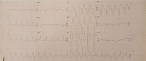 Electrocardiogram demonstrating monomorphic ventricular tachycardia.