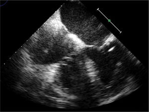 Transesophageal echocardiogram showing disappearance of the previously observed vegetations.
