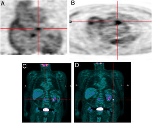 Infective endocarditis in a mechanical aortic valve in a 77-year-old male with a mechanical aortic valve, referred after two weeks of fever and back pain. He presented blood cultures positive for Streptococcus bovis. Transesophageal echocardiography and prospective ECG-gated cardiac CT results were negative for endocarditis. 18F-FDG P ET study revealed hypermetabolism in the aortic valve annulus (SUVmax 2.8) (A and B) and in the lumbar column at L3-L4 level (SUVmax 6.3) (C), and radiopharmaceutical uptake is visible in the descending colon at the splenic angle (SUVmax 7.9) (D). A colonoscopy with biopsy was performed, resulting in the detection of adenocarcinoma of the colon.