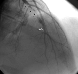 Case 4: coronary angiography image showing multiple thrombotic lesions in the left anterior descending artery at the time of anterior myocardial infarction.