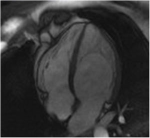 Left ventricular noncompaction in a Fabry disease patient: cardiac magnetic resonance imaging showing hypertrabeculation mostly affecting the left ventricular apical region and lateral wall in apical 4-chamber view.