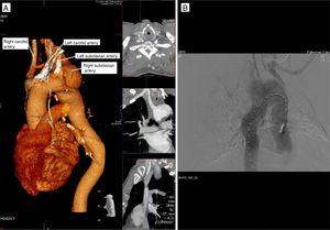 Complementary preoperative studies. (A) Computed tomography angiography reconstruction showing the supraaortic trunks, including an aberrant right subclavian artery; (B) aortography performed to aid planning of endovascular therapy, which was rejected.