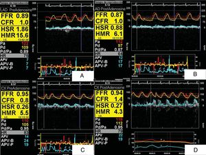 (A) ComboMap® screenshot showing simultaneous pressure and flow measurements recorded in the distal left anterior descending artery (LAD) in baseline conditions, before adenosine administration (fractional flow reserve [FFR] 0.89, coronary flow reserve [CFR] 1, hyperemic stenosis resistance [HSR] 1.86, hyperemic microvascular resistance [HMR] 15.6); (B) following adenosine administration (FFR 0.87, CFR 1, HSR 0.88, HMR 6.1); (C) baseline values in circumflex artery before adenosine administration (FFR 0.95, CFR 0.8, HSR 0.26, HMR 5.5); (D) values in circumflex artery following adenosine administration (FFR 0.94, CFR 1.4, HSR 0.27, HMR 4.3). Note the high HMR before adenosine administration and the greater response to adenosine in the LAD.