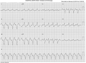 Electrocardiogram showing ventricular tachycardia with right bundle branch block and superior axis (cycle length 330 ms).
