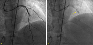 (A) Angiographic image showing severe underexpansion of the stent implanted in the mid anterior descending artery; (B) fluoroscopy image showing the ‘dog-bone’ shape of the previously implanted stent.