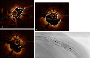 (A) Optical coherence tomography image after the first cycle of coronary lithotripsy showing the severely underexpanded stent implanted under calcified plaque, with areas of rupture and minimum luminal area of 1.97 mm2; (B) optical coherence tomography image after the second cycle of coronary lithotripsy, with minimum luminal area of 3.79 mm2; (C) image of rupture of in-stent calcified plaque after application of coronary lithotripsy; (D) stent boost after application of coronary lithotripsy, showing luminal gain without clarifying the integrity of the scaffold.
