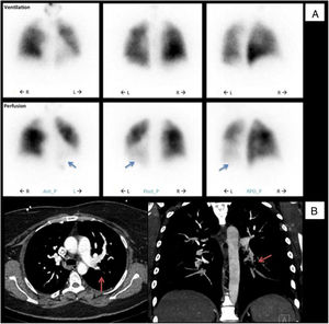 Initial diagnostic procedures. (A) Pulmonary ventilation/perfusion scan with subsegmental perfusion defects (blue arrows) and preserved ventilation in the left lower lobe; (B) computed tomography angiography with a subocclusive stenotic lesion at the origin of the left inferior lobar artery (red arrows). Ant_P: anterior-posterior; L: left; Post-P: postero-posterior; R: right; RPO_P: right posterior oblique-posterior.