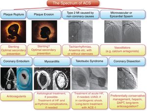 The spectrum of acute coronary syndromes. Compared to men, women present more often with non-ST-elevation myocardial infarction, endothelial erosion is more common in younger female smokers, and Takotsubo syndrome and spontaneous coronary dissection are typical female presentations of acute coronary syndromes (reproduced with permission from Banning et al.26). ACE: angiotensin-converting enzyme inhibitor; DAPT: dual antiplatelet therapy; HF: heart failure; LVAD: left ventricular assist device; MI: myocardial infarction.