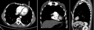 Thoracic computed tomography in February 2017 showing an ovoid encapsulated paracardiac fatty lesion in the left cardiophrenic angle with a soft tissue rim and intrinsic and surrounding soft tissue stranding (arrows), without pleural effusion.