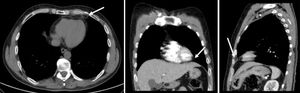 Thoracic computed tomography in April 2017, showing a reduction in the size of the paracardiac lesion (arrows).
