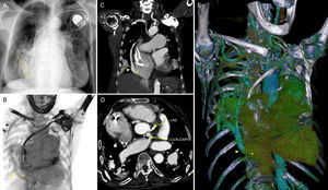 (A) Chest X-ray showing a markedly enlarged cardiac silhouette along with a right-sided tubular opacity (dotted lines) paralleling the heart border; (B and C) computed tomography angiography (CTA), coronal plane, depicting a single right pulmonary vein (arrowhead) connected to the inferior vena cava (*); (D) CTA, axial plane, revealing the presence of an anomalous origin of the left circumflex coronary artery from the right pulmonary artery (arrow), close to the pulmonary bifurcation; (E) CTA with three-dimensional volume rendering. LAD: left anterior descending coronary artery; LCx/ALCAPA: anomalous origin of the left circumflex coronary artery from the right pulmonary artery.