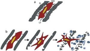 (a) Mechanism of attachment of smooth muscle cells to neighboring elastic laminae via connecting filaments (CFs) composed of fibrillin-1; (b) model of elastolysis in Marfan syndrome, showing how alterations to the synthetic program of smooth muscle cells contribute to early elastolysis, which in turn is associated with infiltration of inflammatory cells into the tunica media, precipitating structural collapse of the vessel wall (adapted from Bunton et al.31). CF: connecting filament; EL: elastic lamina; SMC: smooth muscle cell.