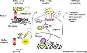 Model of normal regulation of TGF-β by microfibrils and perturbations associated with microfibrillar deficiency in Marfan syndrome (adapted from Ramirez et al.4). LAP: latency-associated peptide; LTBP: latent transforming growth factor binding protein; p: phosphorylation; R-Smad: receptor-activated Smad protein; Smad: small mothers against decapentaplegic protein; TF: transcription factors; TGF-β: transforming growth factor beta.