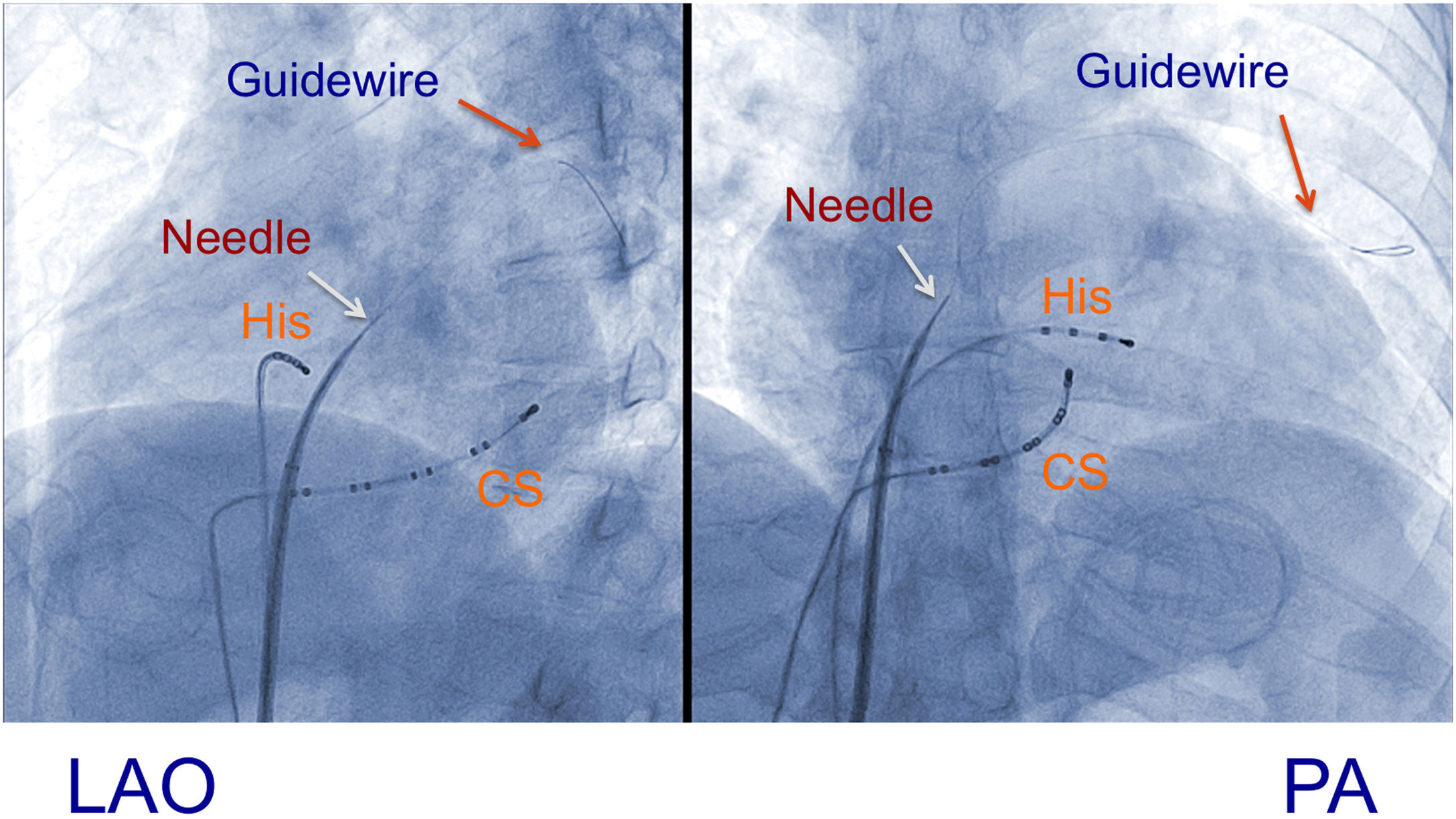 Use of an angioplasty wire in transseptal puncture: A new application ...