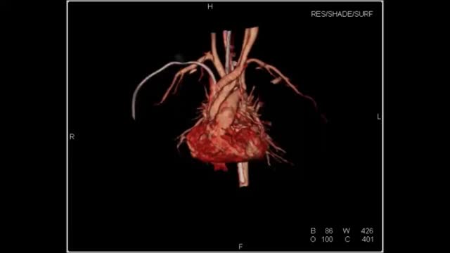 https://ars.els-cdn.com/content/image/1-s2.0-S2174204920302300-mmc2.mp4