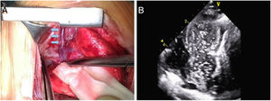Sequential imaging approach to definitive diagnosis of a levoatrial cardinal vein in a neonate: intraoperative assessment. (A) Visualization of the levoatrial cardinal vein by direct inspection during surgery (blue arrows); (B) confirmation of the continuity of the levoatrial cardinal vein with the left atrium by echocardiographic contrast injection.