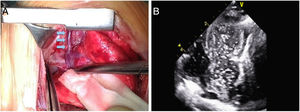 Sequential imaging approach to definitive diagnosis of a levoatrial cardinal vein in a neonate: intraoperative assessment. (A) Visualization of the levoatrial cardinal vein by direct inspection during surgery (blue arrows); (B) confirmation of the continuity of the levoatrial cardinal vein with the left atrium by echocardiographic contrast injection.
