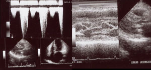 Echocardiogram from the index patient II-1 (performed at the age of 54). Parasternal long axis view, two-dimensional and M-mode, showing asymmetric septal hypertrophy and mitral valve systolic anterior motion. Apical four chamber view and color wave Doppler show major left ventricular outflow tract obstruction. Please note that these 18-years-old echocardiographic images are suboptimal quality since they were obtained from still frames from thermal paper. Unfortunately, there are no better quality images available.