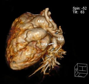 Posterolateral view of three-dimensional computed tomography angiography reconstruction showing the left pulmonary artery branch arising from the anterior aspect of the proximal descending thoracic aorta. AAo: ascending aorta; LPA: left pulmonary artery; DAo: descending aorta.