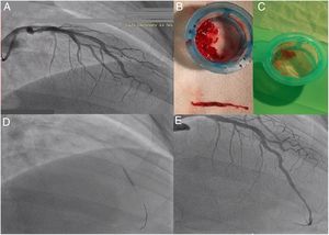 Left coronary artery angiography and angioplasty: (A) initial injection showing the left anterior descending coronary artery with acute thrombosis; aspirated material from the coronary territories, showing white (B) and red thrombi (C); (D) placement of a 2.75 mm×18 mm Resolute Onyx stent; (E) final angiographic result.