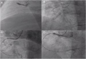 Right coronary artery (RCA) angiography and angioplasty: (A) proximal thrombotic occlusion of the RCA; (B) attempted balloon dilatation; (C) after administration of intracoronary adenosine and nitrates; (D) final result of first angioplasty.