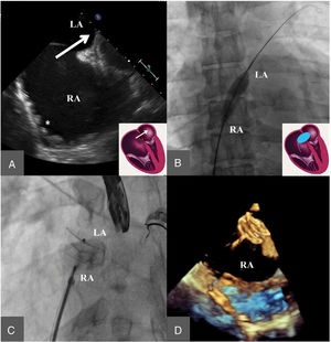 Initial closure of the defect using a cribriform patent foramen ovale (PFO) device. A: Transesophageal echocardiogram image where a PFO can be observed, with right-to-left shunt (arrow) and hypertrabeculation of the right atrium (RA) (ventricularization of the RA) (asterisk). B: Transitory occlusion test. C&D: Cribiform PFO closure device released at the PFO, radioscopy image (C) and three-dimensional transesophageal echocardiogram (D).
