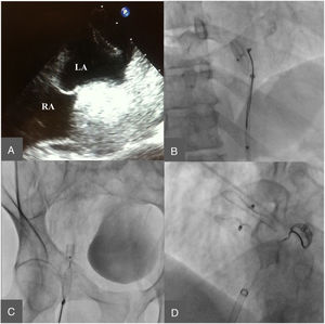 Cribriform patent foramen ovale occluder embolization and extraction with final implant of the atrial septal defect (ASD) device. A: Transesophageal echography image where the device can be visualized with free movement at the left atrium. B: Device capture at the descending aorta. C: Device extraction through the right femoral artery. D: Final implant of the ASD device.