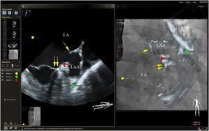 Fusion imaging for LAA occlusion. Left: TEE with coumadin ridge (yellow arrow) and the mitral annulus (double yellow arrows). Right: fusion imaging of TEE and fluoroscopy, with the guide catheter passing through the optimal site for transseptal puncture (yellow) and other anatomical structures previously marked – the left circumflex coronary artery (red) and the tip of the LAA (green). TEE: transesophageal echocardiography; LA: left atrium; LAA, left atrial appendage. Image from Wiley et al.2, reproduction allowed.