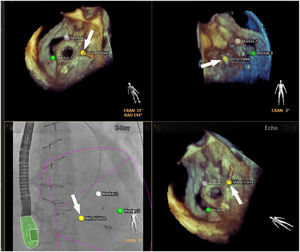 Fusion imaging for paravalvular leaks closure. There are two paravalvular leaks, a large between the green and pink markers and a small one with a yellow landmark (white arrow). The landmarks registered in the TEE images are automatically synchronized with fluoroscopy (bottom left corner). The catheter is visible through the smaller leak (white arrow, bottom right corner). TEE: transesophageal echocardiography. Image from Basman et al.4, reproduction allowed.