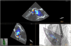 Fusion imaging in TAVR. Valve deployment is visualized on TEE with doppler mode and overlaid onto fluoroscopy (bottom right corner). TAVR: transcatheter aortic valve replacement; TEE: transesophageal echocardiography. Image from Basman et al.4, reproduction allowed.