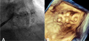 A: Final angiographic result after the release of both devices. B: Final result three-dimensional transesophageal echocardiography image, where we can see all devices.
