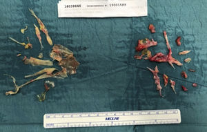 Typical surgical specimen of molded casts.